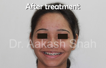 Aakash orthodontics Latest Cases