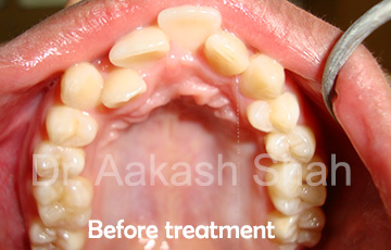 Aakash orthodontics Latest Cases