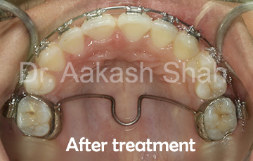 Aakash orthodontics Latest Cases