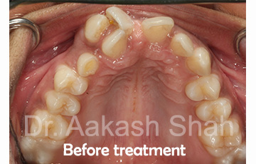 Aakash orthodontics Latest Cases