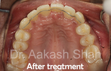 Aakash orthodontics Latest Cases