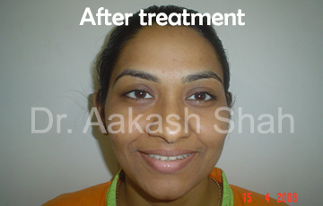 Aakash orthodontics Latest Cases